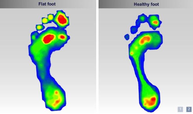 Effective insoles redistribute your weight to reduce “hot spots”.
