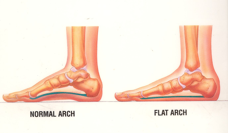What's to know about flat feet? - Bauerfeind Polyclinic | Foot Care ...